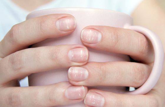 blancas en las uñas: ¿son síntoma déficit de calcio? Atida